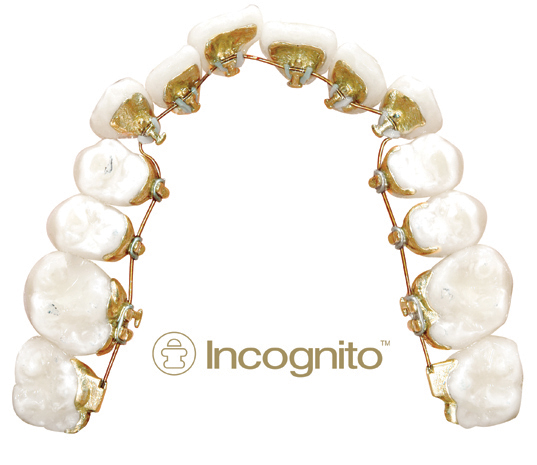Incognito Lingual braces behind the teeth